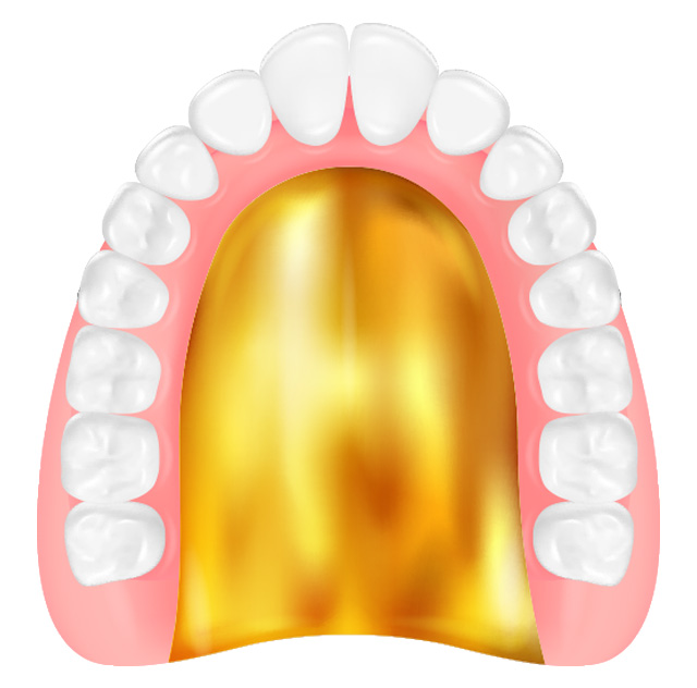 ゴールド床義歯